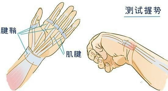 手指经常酸痛无力?一个动作,测试你是否患上腱鞘炎!